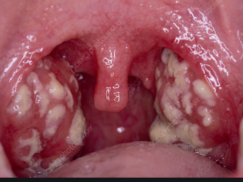 Ekran Alıntısı tonsillit